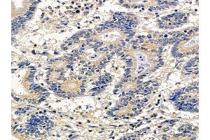 ABIN6260104 and ABIN6278139 at 1/100 staining human colorectal cancer by IHC-P. (ATG4A Antikörper  (N-Term))