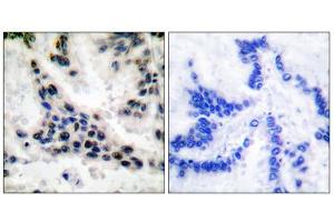Immunohistochemical analysis of paraffin-embedded human lung carcinoma tissue, using HDAC1 antibody (ABIN5976420). (HDAC1 Antikörper  (C-Term))