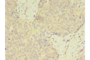 Immunohistochemistry of paraffin-embedded human gastric cancer using ABIN7175049 at dilution of 1:100 (C2ORF69 Antikörper  (AA 117-269))