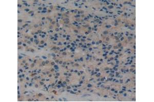 IHC-P analysis of Human Prostate Gland Cancer Tissue, with DAB staining. (PLAT Antikörper  (AA 311-562))