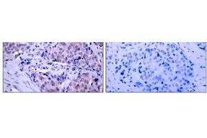 Immunohistochemical analysis of paraffin- embedded human breast carcinoma tissue using PDK1 (Ab-241) antibody (E021005). (PDPK1 Antikörper)