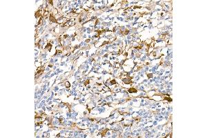 Immunohistochemistry of paraffin-embedded Human Hodgkin lymphoma (positive control antibody staining, clone 55k-2) using Fascin/FSCN1 antibody (ABIN7267142) at dilution of 1:100 (40x lens). (Fascin Antikörper)