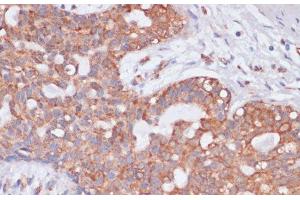 Immunohistochemistry of paraffin-embedded Human breast cancer using KCNH2 Polyclonal Antibody at dilution of 1:100 (40x lens). (KCNH2 Antikörper)