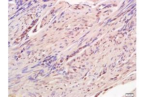 Formalin-fixed and paraffin embedded human endometrium labeled with Anti-CREB-1 Polyclonal Antibody, Unconjugated (ABIN723950) at 1:200 followed by conjugation to the secondary antibody and DAB staining (CREB1 Antikörper  (AA 101-150))