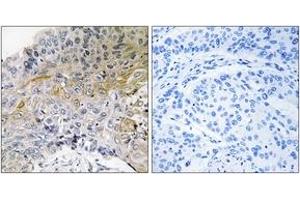 Immunohistochemistry analysis of paraffin-embedded human breast carcinoma tissue, using p130 Cas (Ab-410) Antibody. (BCAR1 Antikörper  (AA 376-425))