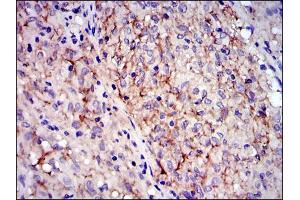 Immunohistochemical analysis of paraffin-embedded gastrointestinal stromal tumor using KIT mouse mAb with DAB staining.