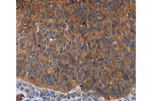 Immunohistochemistry of Human lung cancer using JUP Polyclonal Antibody at dilution of 1:50 (JUP Antikörper)