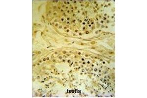 I Antibody (C-term) (ABIN653307 and ABIN2842806) IHC analysis in formalin fixed and paraffin embedded human testis carcinoma followed by peroxidase conjugation of the secondary antibody and DAB staining. (IMP4 Antikörper  (C-Term))