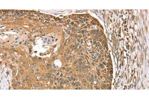 Immunohistochemistry of paraffin-embedded Human esophagus cancer using MORF4L1 Polyclonal Antibody at dilution of 1:35 (MORF4L1 Antikörper)