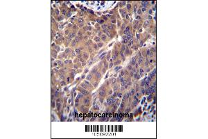 ARL2 Antibody immunohistochemistry analysis in formalin fixed and paraffin embedded human hepatocarcinoma followed by peroxidase conjugation of the secondary antibody and DAB staining. (ARL2 Antikörper  (C-Term))
