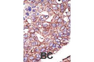 Formalin-fixed and paraffin-embedded human cancer tissue reacted with SYVN1 polyclonal antibody  , which was peroxidase-conjugated to the secondary antibody, followed by DAB staining. (SYVN1 Antikörper  (C-Term))