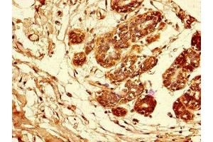 Immunohistochemistry of paraffin-embedded human breast cancer using ABIN7144028 at dilution of 1:100 (Amphiregulin Antikörper  (AA 107-148))