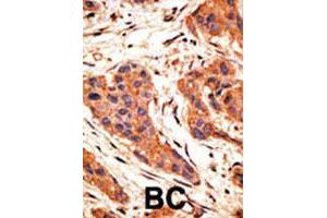 Formalin-fixed and paraffin-embedded human breast cancer tissue reacted with SNAI1 polyclonal antibody  , which was peroxidase-conjugated to the secondary antibody, followed by AEC staining. (SNAIL Antikörper  (AA 9-39))