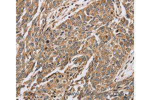 Immunohistochemistry of Human lung cancer using PTGER2 Polyclonal Antibody at dilution of 1:45 (PTGER2 Antikörper)