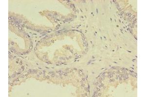 Immunohistochemistry of paraffin-embedded human prostate cancer using ABIN7159642 at dilution of 1:100 (MTHFR Antikörper  (AA 1-656))