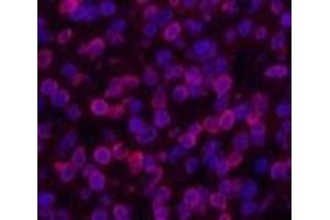 Immunofluorescence analysis of Human lung cancer tissue using Lamin B1 Monoclonal Antibody at dilution of 1:200. (Lamin B1 Antikörper)