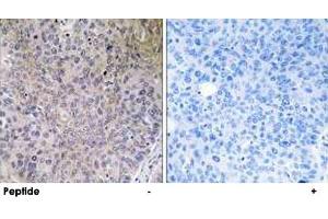 Immunohistochemistry analysis of paraffin-embedded human lung carcinoma tissue using NDUFS7 polyclonal antibody . (NDUFS7 Antikörper)