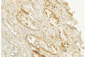 ABIN6262478 and ABIN6272858 at 1/100 staining Human pancreatic cancer by IHC-P. (IFT20 Antikörper)
