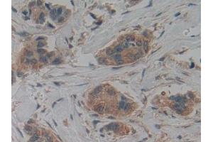 Detection of CK9 in Human Breast cancer Tissue using Polyclonal Antibody to Cytokeratin 9 (CK9) (KRT9 Antikörper  (AA 315-456))