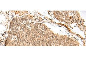 Immunohistochemistry of paraffin-embedded Human esophagus cancer tissue using GEMIN4 Polyclonal Antibody at dilution of 1:30(x200) (GEMIN4 Antikörper)