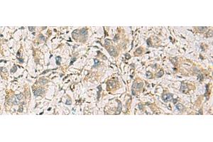 Immunohistochemistry of paraffin-embedded Human liver cancer tissue using CMTM1 Polyclonal Antibody at dilution of 1:40(x200) (CMTM1 Antikörper)