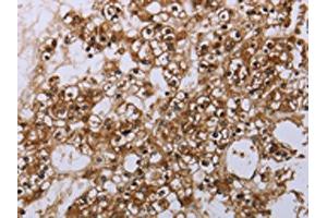 The image is immunohistochemistry of paraffin-embedded human prostate cancer tissue using ABIN7190062(CASP8AP2 Antibody) at dilution 1/20. (FLASH Antikörper)