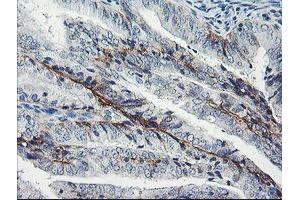 Immunohistochemical staining of paraffin-embedded Adenocarcinoma of Human endometrium tissue using anti-DTNB mouse monoclonal antibody.