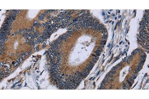 Immunohistochemistry of paraffin-embedded Human colon cancer using IPO4 Polyclonal Antibody at dilution of 1:50 (Importin 4 Antikörper)
