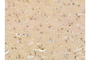 ABIN6265624 and ABIN6266916 at 1/100 staining human glioblastoma by IHC-P. (TNFAIP2 Antikörper  (N-Term))