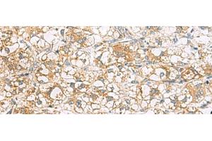 Immunohistochemistry of paraffin-embedded Human liver cancer tissue using TLE6 Polyclonal Antibody at dilution of 1:75(x200) (TLE6 Antikörper)