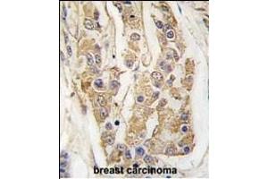 Formalin-fixed and paraffin-embedded human breast carcinoma tissue reacted with COT Antibody (C-term) (ABIN392472 and ABIN2842056) , which was peroxidase-conjugated to the secondary antibody, followed by DAB staining. (MAP3K8 Antikörper  (C-Term))