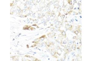 Immunohistochemistry of paraffin-embedded Human liver cancer using HSD17B10 Polyclonal Antibody at dilution of 1:100 (40x lens). (HSD17B10 Antikörper)