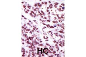 Formalin-fixed and paraffin-embedded human hepatocellular carcinoma tissue reacted with PRKCE polyclonal antibody  , which was peroxidase-conjugated to the secondary antibody, followed by AEC staining . (PKC epsilon Antikörper  (AA 213-243))