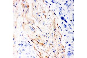 Anti- Decorin Picoband antibody, IHC(P) IHC(P): Human Mammary Cancer Tissue (Decorin Antikörper  (AA 31-359))