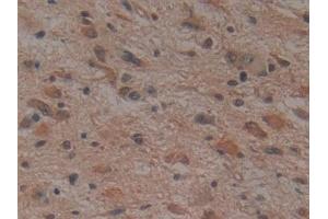 Detection of NOG in Human Glioma Tissue using Monoclonal Antibody to Noggin (NOG) (NOG Antikörper  (AA 28-232))