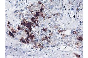 Immunohistochemical staining of paraffin-embedded Adenocarcinoma of Human breast tissue using anti-SERPINB2 mouse monoclonal antibody. (SERPINB2 Antikörper)