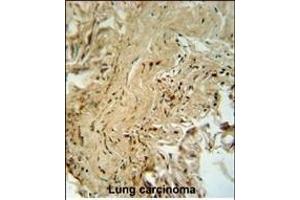 PK14 Antibody (/) f immunohistochemistry analysis in forlin fixed and paraffin embedded hun lung carcino followed by peroxidase conjugation of the secondary antibody and DAB staining. (MAPK14 Antikörper  (AA 158-192))