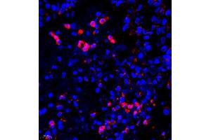 Immunofluorescence of paraffin embedded human lung cancer using UBE3A (ABIN7076105) at dilution of 1:650 (400x lens) (ube3a Antikörper)