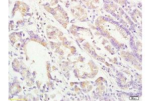 Formalin-fixed and paraffin embedded human gastric carcinoma labeled with Rabbit Anti ApoA4 Polyclonal Antibody, Unconjugated  at 1:200 followed by conjugation to the secondary antibody and DAB staining (APOA4 Antikörper  (AA 21-120))