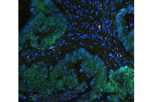 IF analysis of TPR using anti-TPR antibody (ABIN5693275) TPR was detected in paraffin-embedded section of human intestinal cancer tissues. (TPR Antikörper)