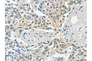 The image on the left is immunohistochemistry of paraffin-embedded Human breast cancer tissue using ABIN7190467(DGKB Antibody) at dilution 1/60, on the right is treated with synthetic peptide. (DGKB Antikörper)