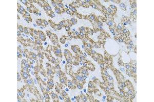 Immunohistochemistry of paraffin-embedded Human liver damage using NTF4 Polyclonal Antibody at dilution of 1:100 (40x lens). (Neurotrophin 4 Antikörper)