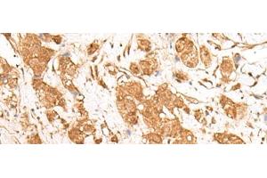 Immunohistochemistry of paraffin-embedded Human breast cancer tissue using GANC Polyclonal Antibody at dilution of 1:55(x200)