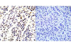 Immunohistochemical analysis of paraffin-embedded human malignant lymphoma tissue using Histone H3. (Histone H3.1 Antikörper  (pSer28))