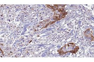 ABIN6266643 at 1/100 staining Human urothelial cancer tissue by IHC-P. (TGFA Antikörper)