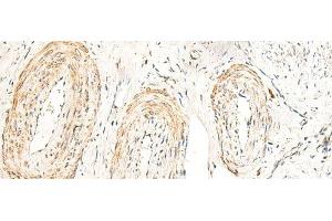 Immunohistochemistry of paraffin-embedded Human cervical cancer tissue using GPR160 Polyclonal Antibody at dilution of 1:35(x200) (GPR160 Antikörper)