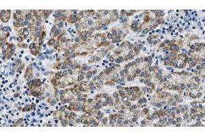 ABIN6275017 at 1/100 staining Human liver cancer tissue by IHC-P. (Claudin 6 Antikörper  (Internal Region))