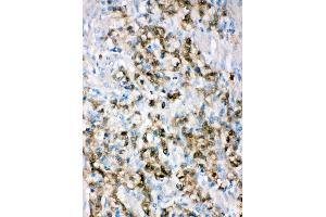 Anti-ALDH3A1 antibody, IHC(P) IHC(P): Human Gastric Cancer Tissue