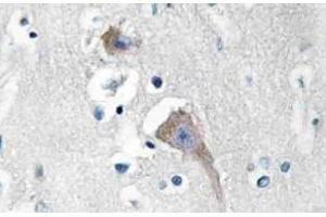 Immunohistochemistry (IHC) analyzes of CaMKIIalpha/delta antibody in paraffin-embedded human breast carcinoma tissue. (CAMK2A Antikörper)
