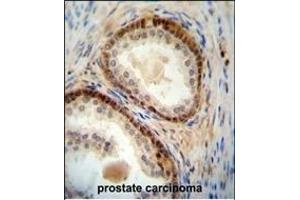 NUDT8 antibody (N-term) (ABIN654517 and ABIN2844241) immunohistochemistry analysis in formalin fixed and paraffin embedded human prostate carcinoma followed by peroxidase conjugation of the secondary antibody and DAB staining. (NUDT8 Antikörper  (N-Term))